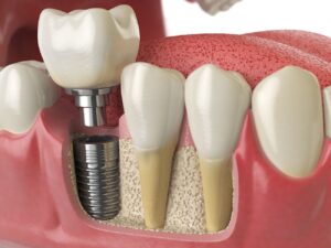 implant dentistry Gaithersburg Maryland