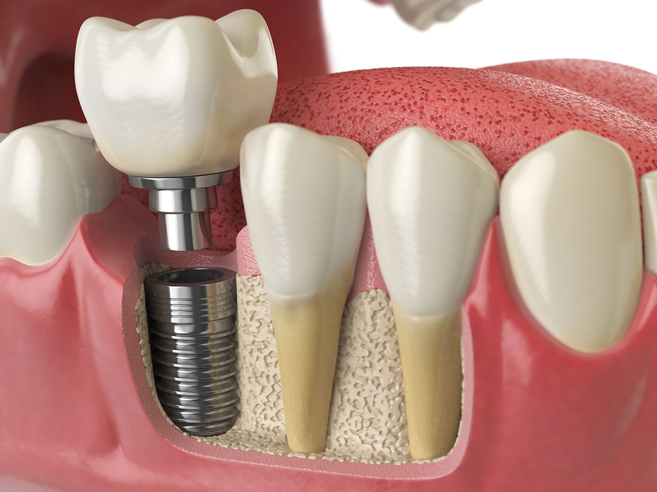 What Is a Dental Implant Restorative Dentist in Gaithersburg, MD