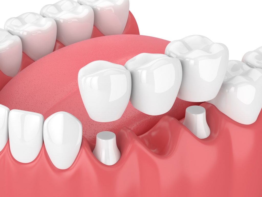 3D jaw receiving dental bridges Gaithersburg Maryland