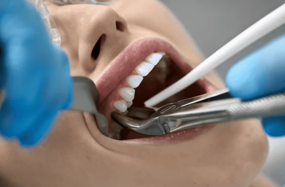 closeup of tooth extraction recovery tips dentists in Gaithersburg Maryland