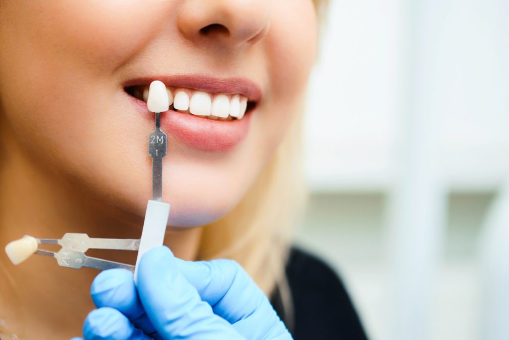 close-up of woman getting dental veneer consultation dentist in Gaithersburg Maryland
