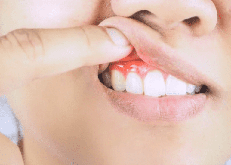 Common Causes of Gum Disease