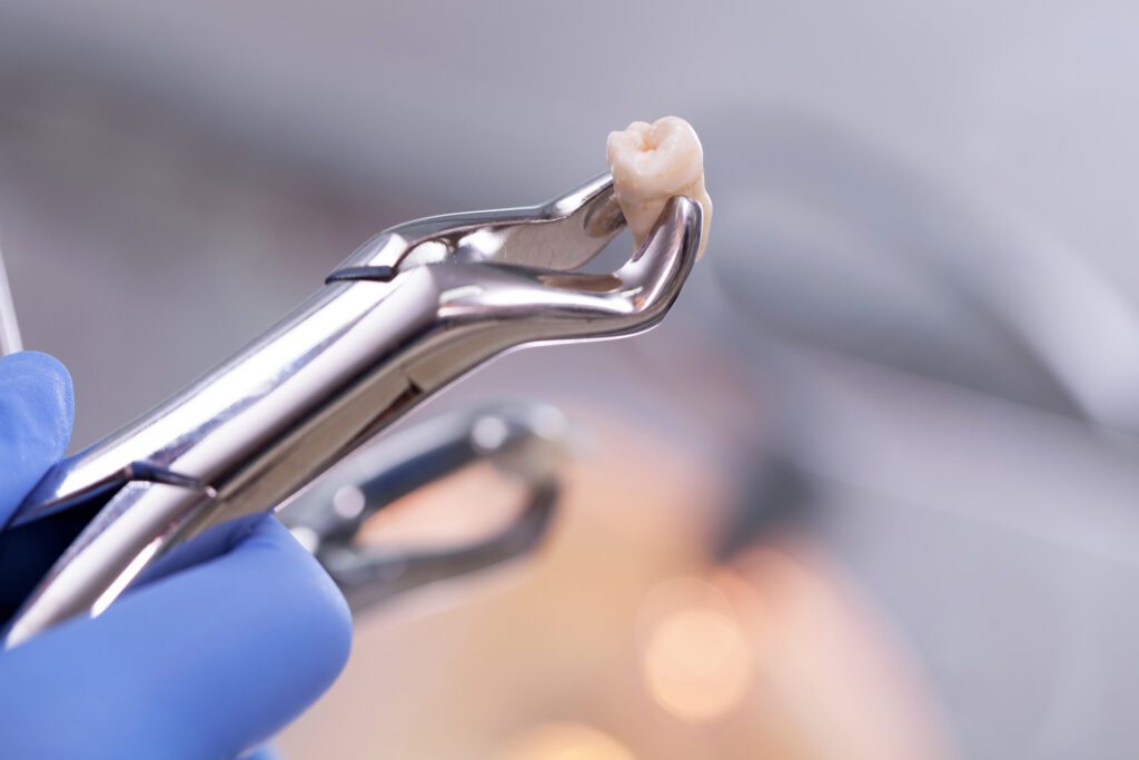 Tooth Extraction in Gaithersburg MD could be necessary to help protect the rest of your teeth and gums