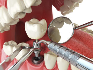 Dental implants serve as a long-term solution, offering numerous benefits such as improved chewing ability.