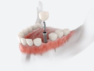 Understanding the process for dental implants could help alleviate anxiety and ensures a smooth experience.