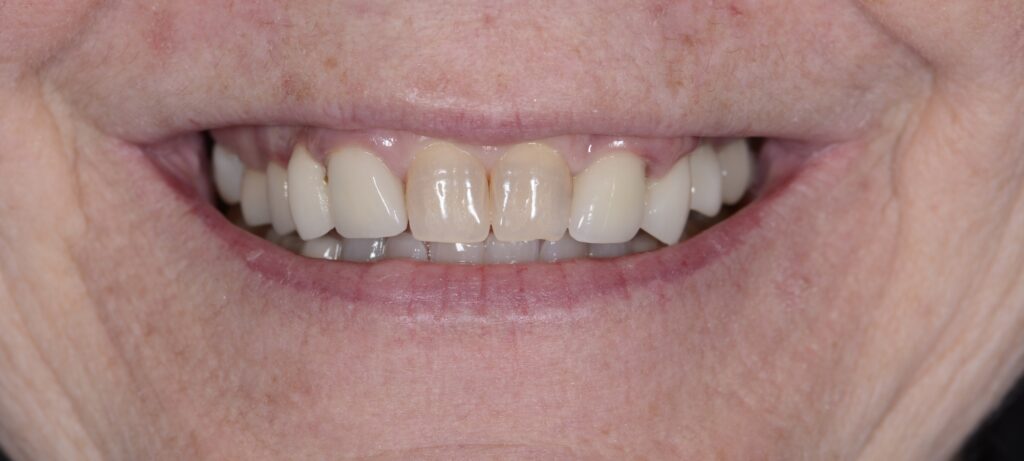 Before cosmetic dentistry at TotallySmiles Dental Group