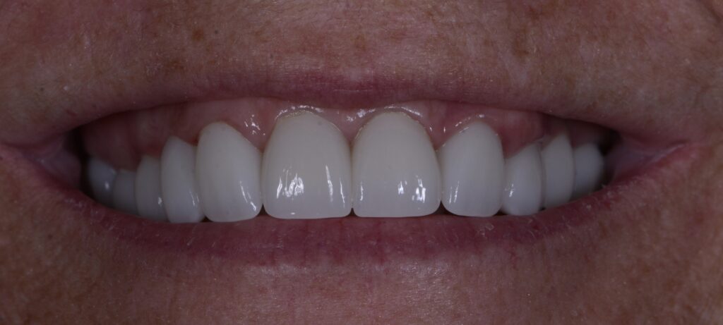 After cosmetic dentistry at TotallySmiles Dental Group