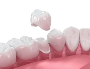 Same-Day Crowns: What to Expect in Gaithersburg, MD